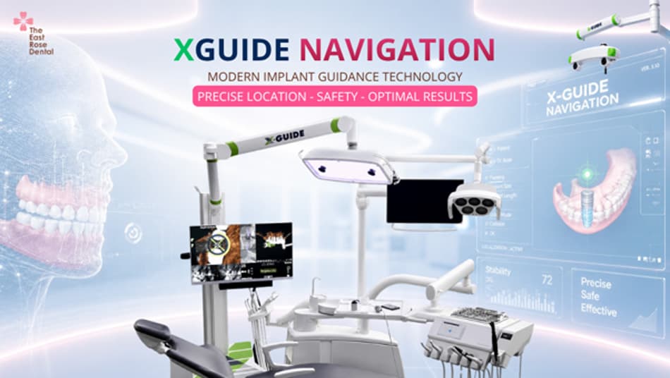 X-guide Navigation in Dental Implant Surgery: Advanced Precision Technology in Modern Dentistry