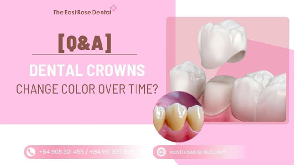 Do Dental Crowns Change Color Over Time? How Can It Be Treated?