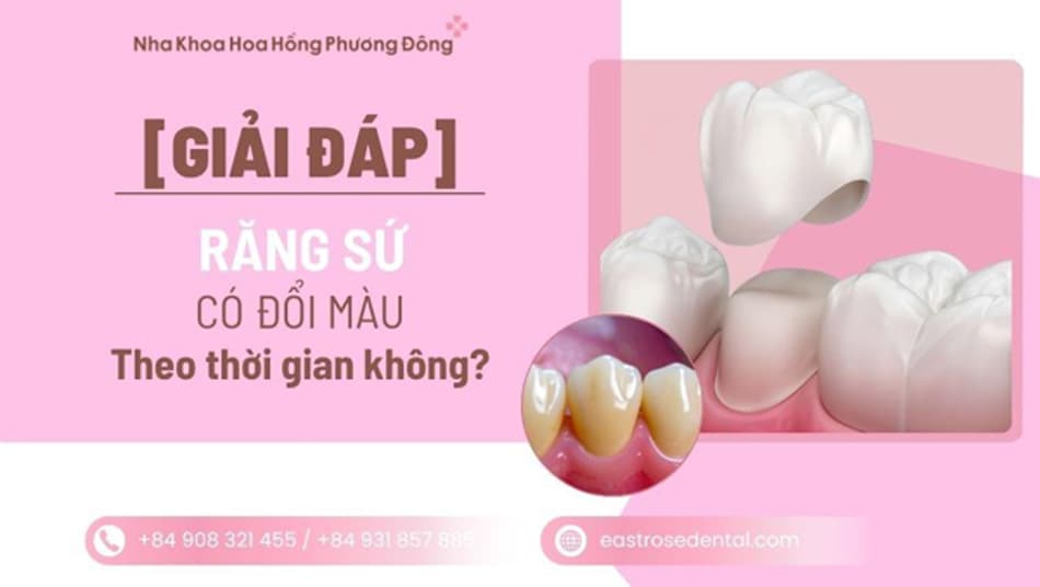 Răng sứ có bị đổi màu theo thời gian không? Xử lý như thế nào?