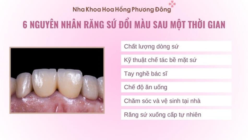 Răng sứ có thể đổi màu tự nhiên sau một thời gian dài sử dụng