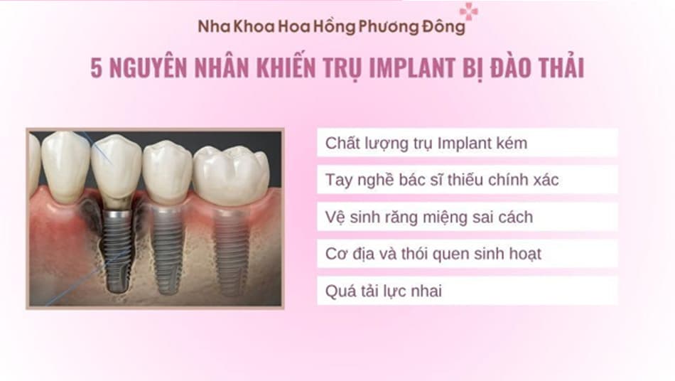 Một số nguyên nhân dẫn đến việc Implant không thể tích hợp với xương hàm