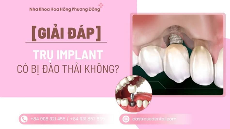 Implant có bị đào thải không? 4 dấu hiệu cơ thể không nhận trụ