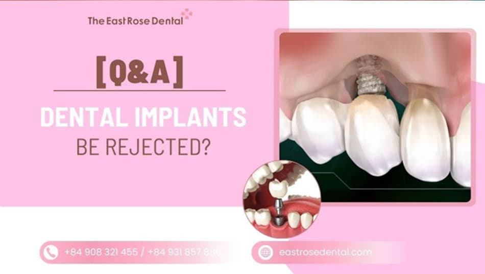 Can Dental Implants Be Rejected? 4 Warning Signs to Know 