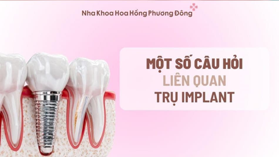 Một số câu hỏi liên quan đến trụ Implant