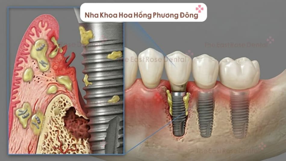 Một số dấu hiệu nhận biết sớm việc trụ Implant bị đào thải