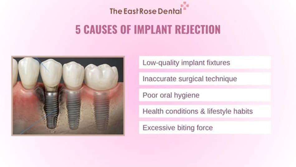 Some causes that prevent dental implants from integrating with the jawbone