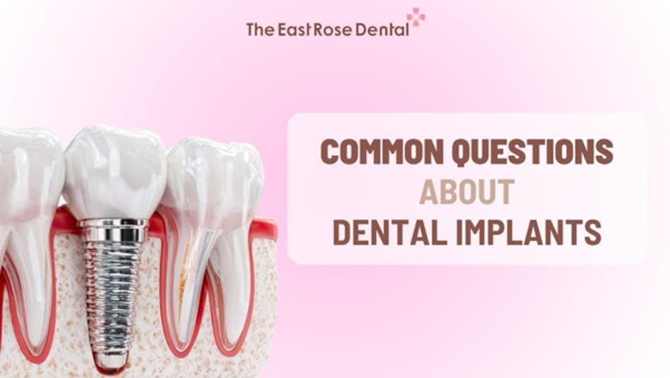 Some common questions related to dental implants 