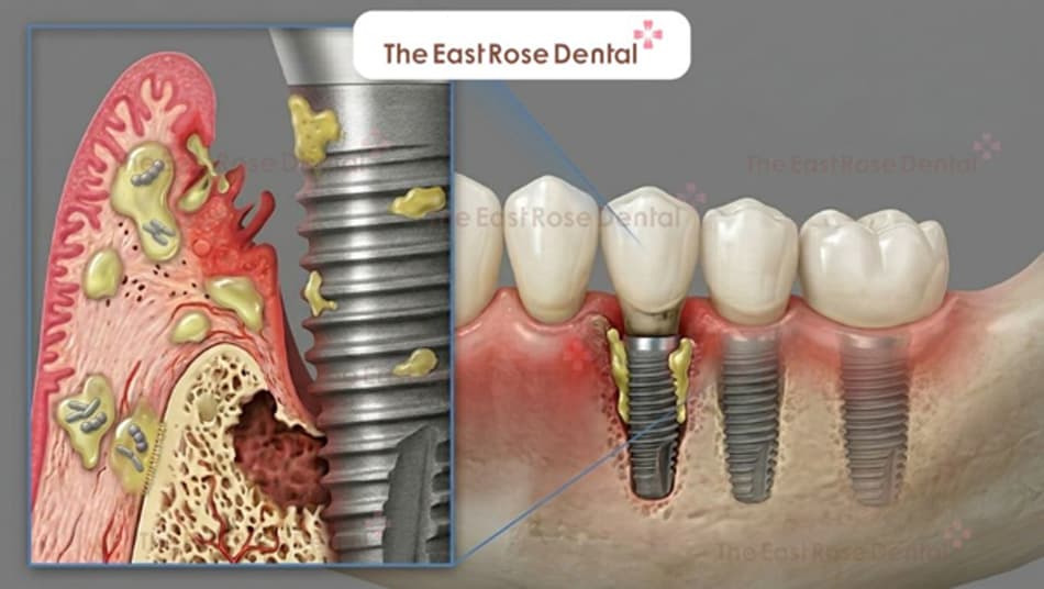 Some early warning signs of dental implant rejection 