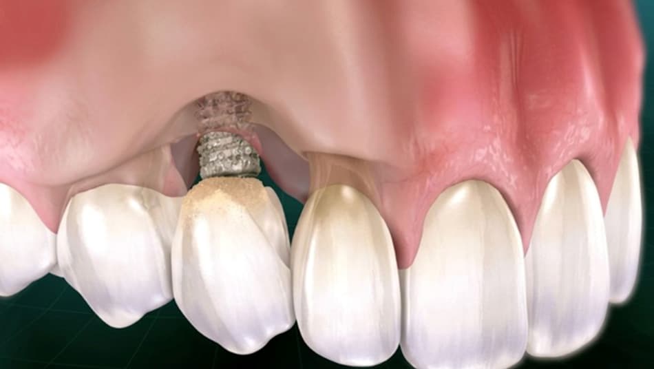 Visible implant threads require immediate treatment 