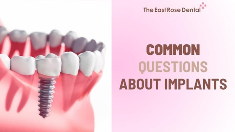 Common Questions About Dental Implants, Airport Security, and MRI Scans