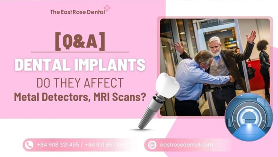 Do dental implants affect MRI scans or trigger metal detectors at airport security? 
