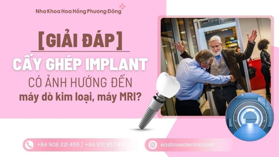 Implant có ảnh hưởng đến MRI, máy dò kim loại hay kiểm tra an ninh không?