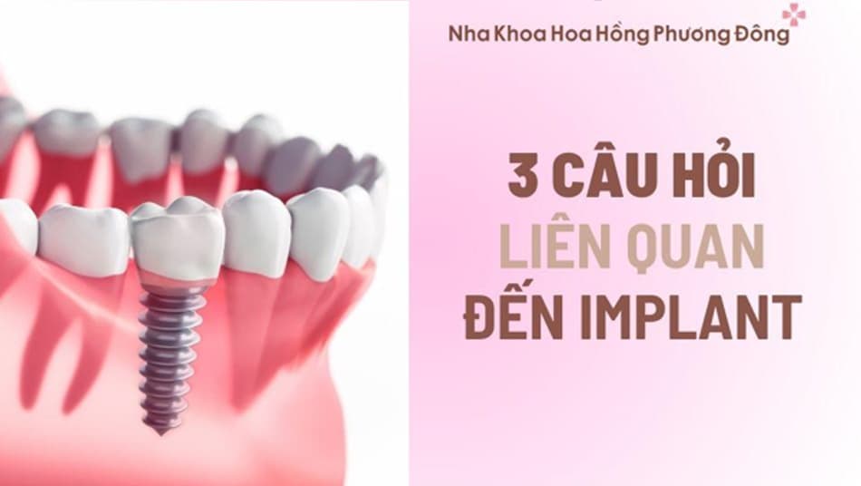 Một số câu hỏi xoay quanh cấy ghép implant và thủ tục an ninh hoặc chụp MRI