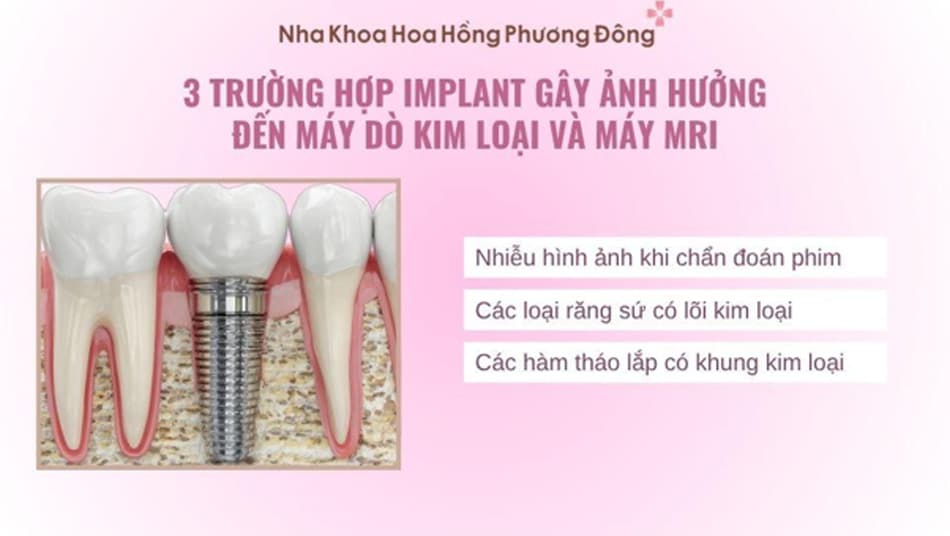Một số trường hợp Implant vẫn ảnh hưởng đến chụp MRI và kiểm tra an ninh