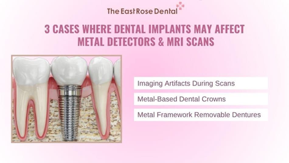 Some types of dental implants may still affect MRI scans or security screening