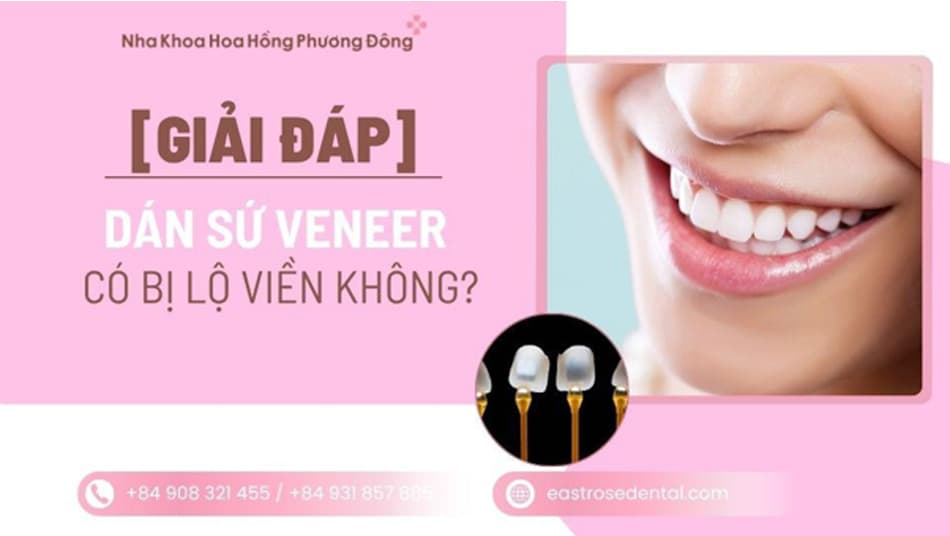 Dán sứ Veneer có bị lộ viền không? Vì sao có người nhìn rất giả?
