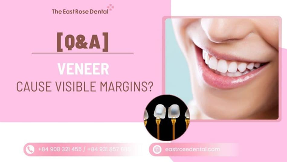 Do Veneers show exposed margins? Why do some look fake? 
