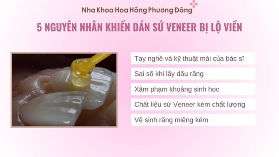 Một số nguyên nhân khiến răng sứ Veneer bị lộ viền sau một thời gian sử dụng