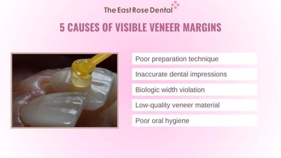 Some causes of visible veneer margins after long-term use 