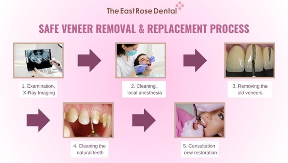 5 Steps for Safe Veneer Removal and Replacement 