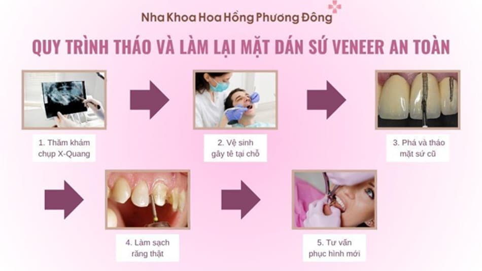 5 bước tháo và kiểm tra phục hình lại răng sứ Veneer