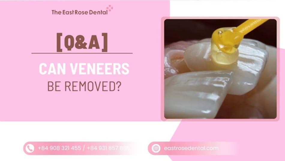 Can Veneers Be Removed? Understanding the Removal Process 