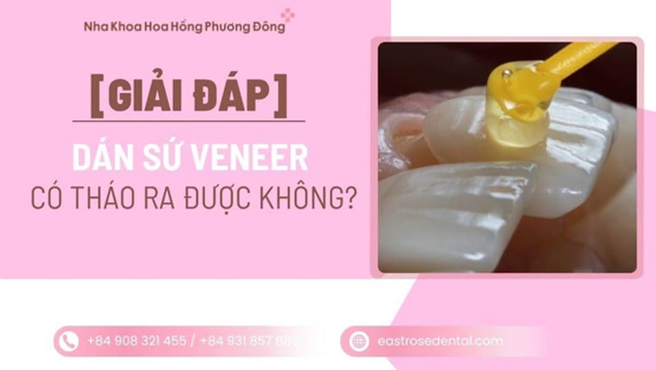 Dán sứ Veneer có tháo ra được không? Quy trình như thế nào?