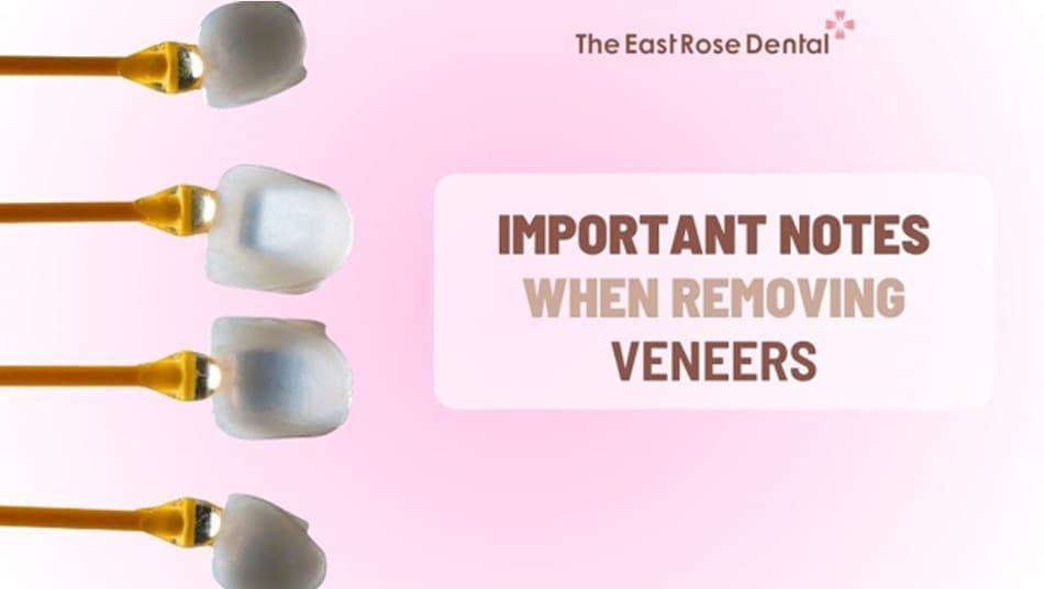 Important Things to Know Before Removing Porcelain Veneers