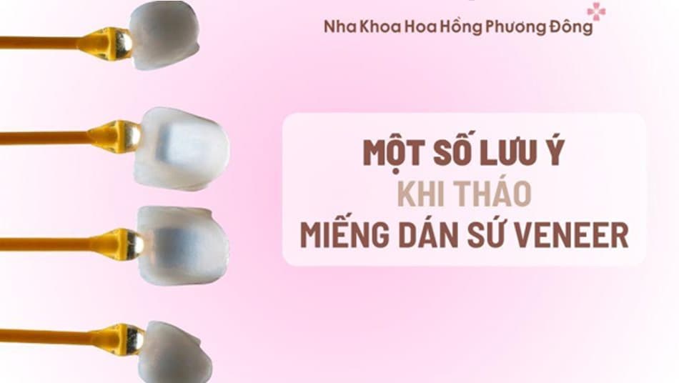 Một số lưu ý quan trọng cần biết trước khi tháo bỏ răng sứ Veneer