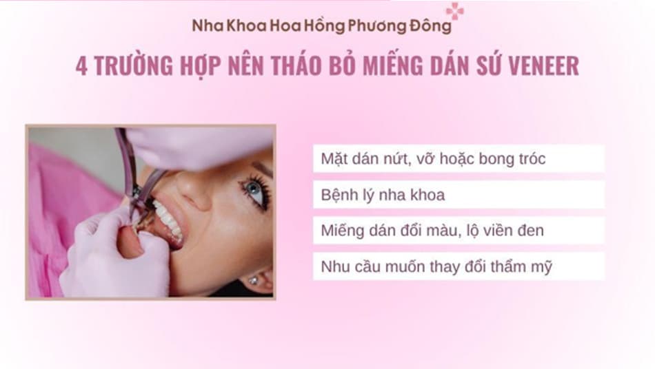 Một số trường hợp nên tháo bỏ miếng dán sứ Veneer