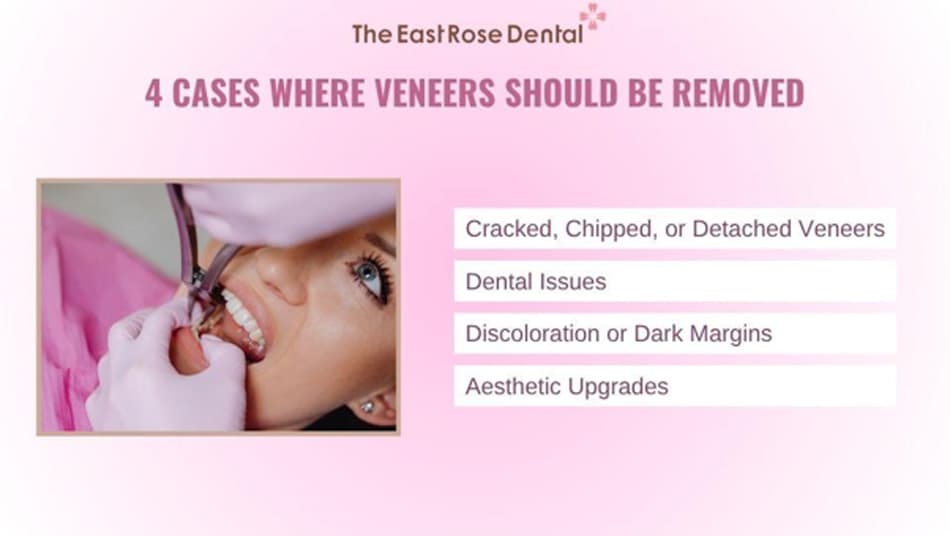 Situations Where Porcelain Veneers May Need to Be Removed