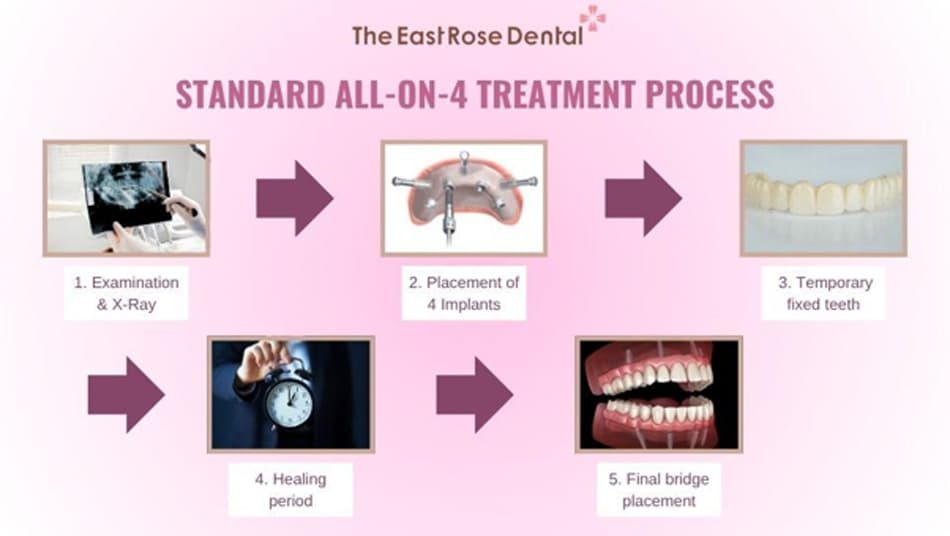 All-on-4 is a complex restoration method that requires strict medical standards