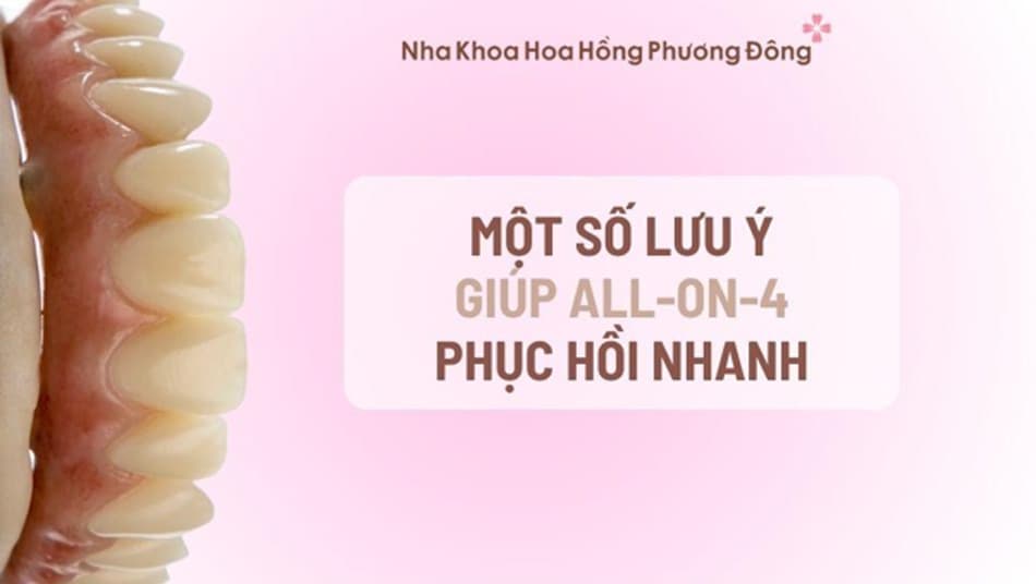 Một số lưu ý giúp việc cấy ghép All-on-4 diễn ra thuận lợi và rút ngắn thời gian