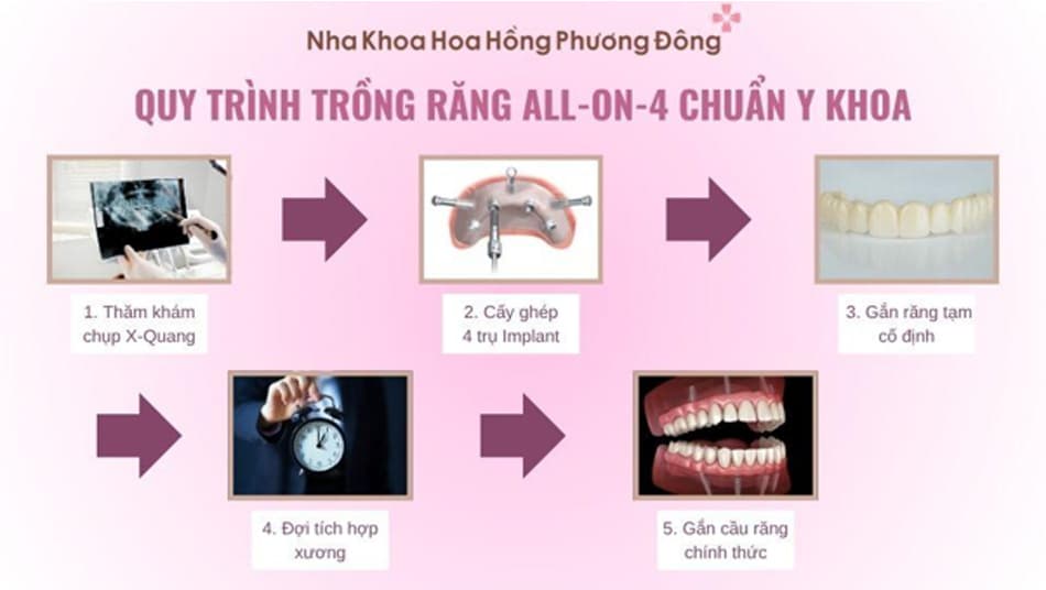 All-on-4 là phương pháp phục hình phức tạp và yêu cầu đảm bảo nghiêm ngặt