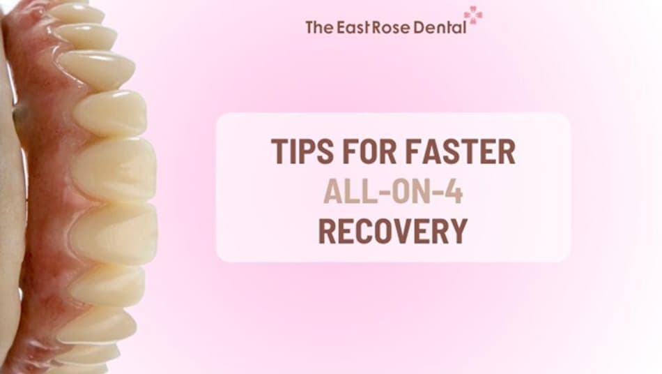 Some important tips to help All-on-4 treatment go smoothly and support faster recovery