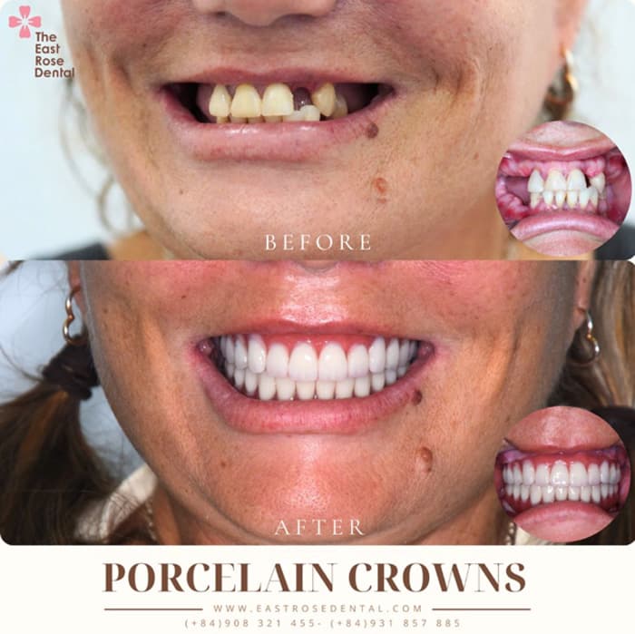 All-on-4 Restoration Results at The East Rose Dental 