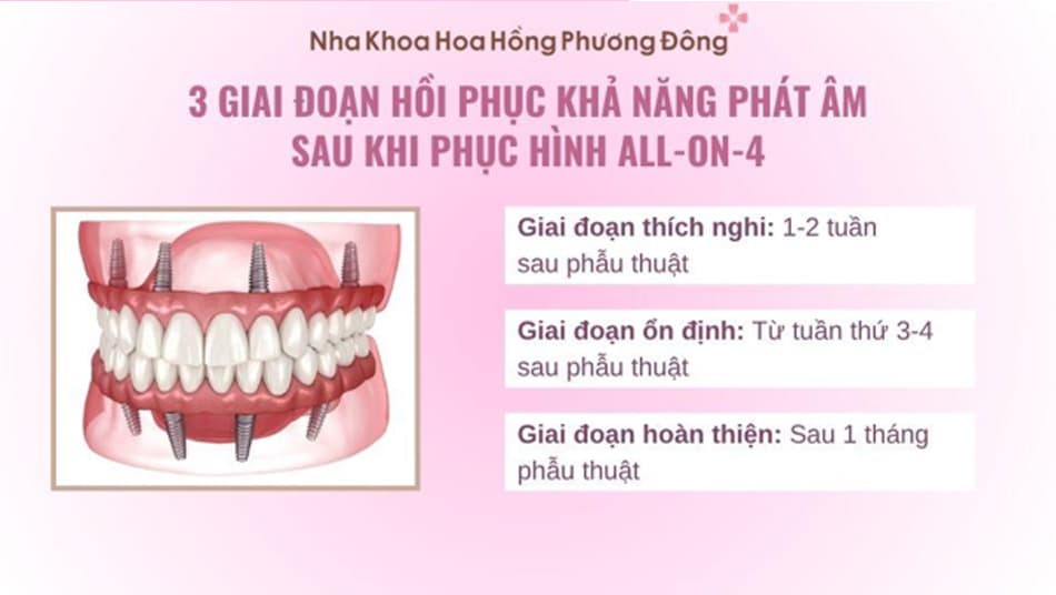 Khách hàng cần thời gian để phục hồi khả năng phát âm sau khi phục hình All-on-4