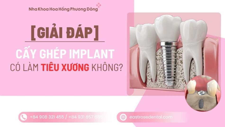 Cấy ghép Implant có gây tiêu xương ngược không? Sự thật bạn cần biết