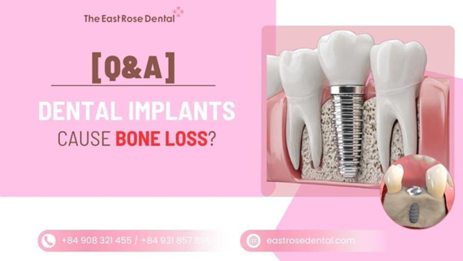 Can Dental Implants Cause Bone Loss? The Truth Explained 