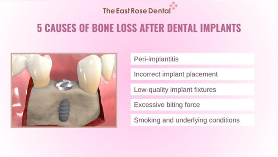 Causes of bone loss after dental Implant placement over time 