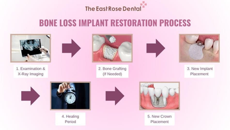 Implant restoration process after bone loss occurs 