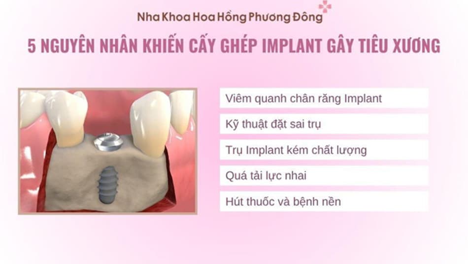 Nguyên nhân tiêu xương sau khi cấy ghép Implant sau một thời gian