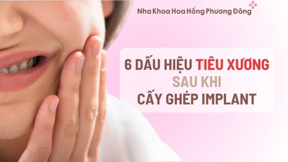 Những dấu hiệu của việc tiêu xương sau khi cấy ghép Implant