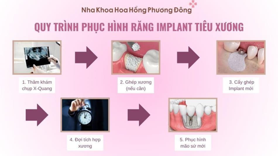Quy trình phục hồi răng Implant sau khi bị tiêu xương