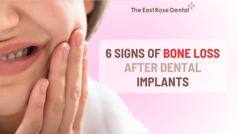 Signs of bone loss after dental Implant placement 