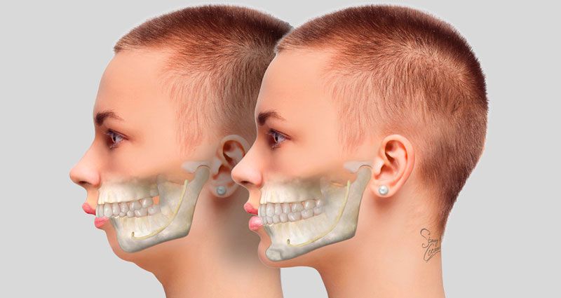 Phẫu thuật hàm hô mất bao lâu thì lành và hết sưng?