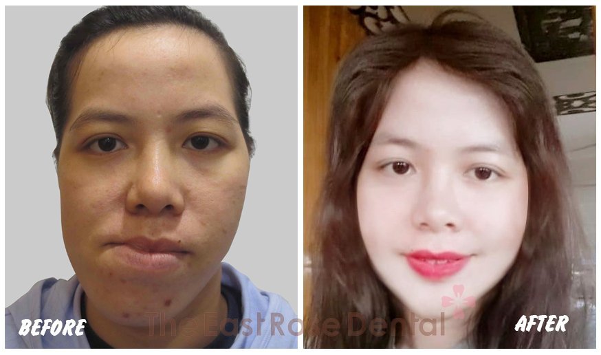 Jaw - facial surgery 2