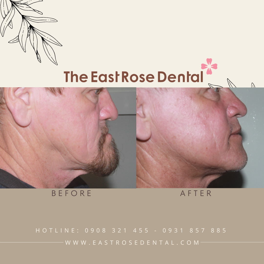 Jaw - facial surgery 1