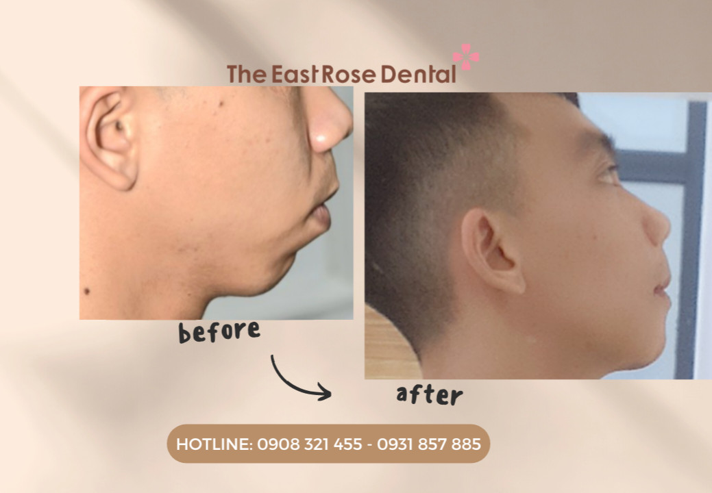 Jaw - facial surgery