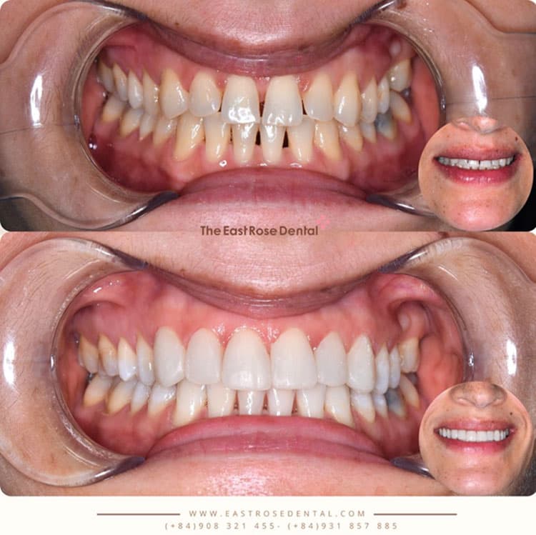 Composite fillings improve the condition of gapped teeth
